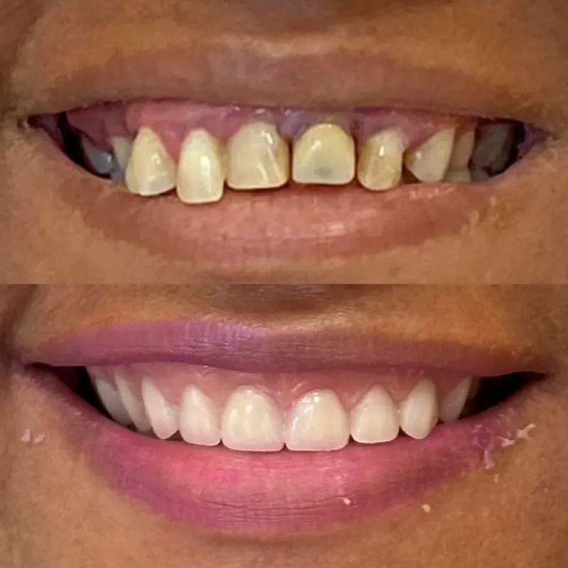 Antes e depois de paciente da clínica, caso 5